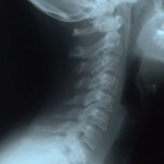 neck_x_ray_full_size_portrait This is not Skippy\'s neck x-ray and only here for dramatic effect.