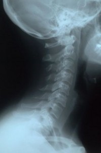 This is not Skippy\'s neck x-ray and only here for dramatic effect.