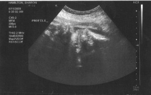 Ultrasound image of Nora's profile on 8-11-2009 at 34 weeks.