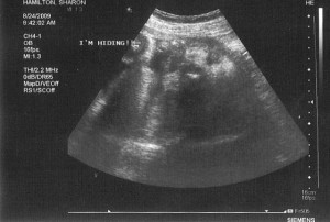 Ultrasound image of Nora's little face poking through on 8-24-2009 at 36 weeks.